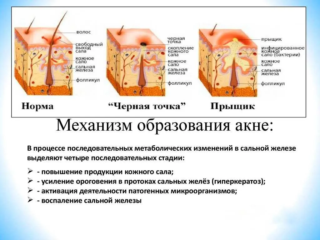 Механизм образования акне.