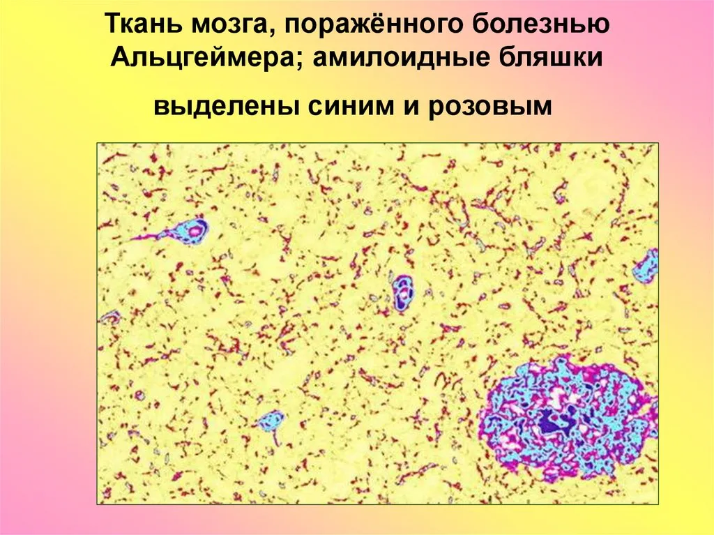 Ткани мозга. Болезнь Альцгеймера микропрепарат. Болезнь Альцгеймера микропрепарат патанатомия. Болезнь Альцгеймера патанатомия. Сенильные бляшки при болезни Альцгеймера.