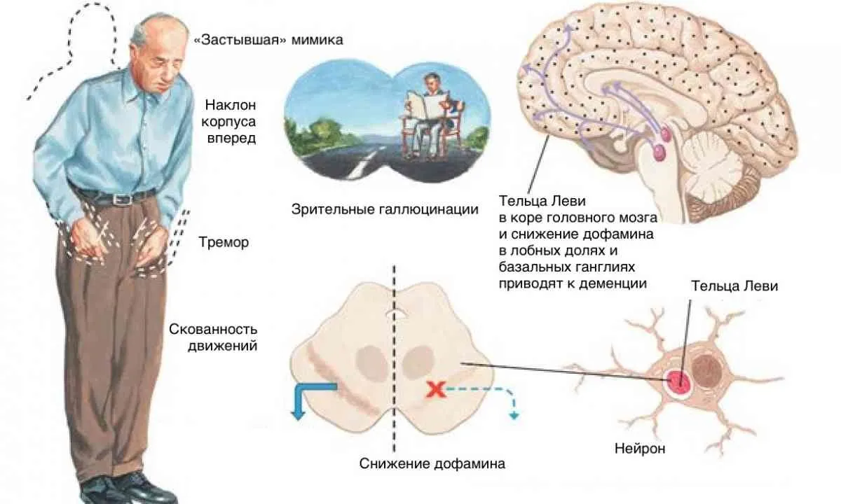 Деменция картинки для презентации